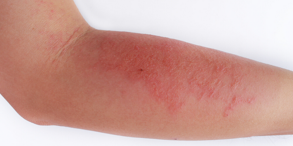 Topical botanicals prove effective for pediatric atopic dermatitis