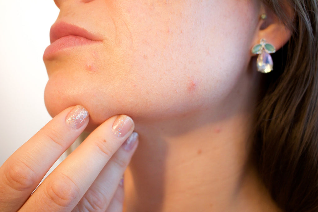 4 Reasons You Might Be Suffering From Acne