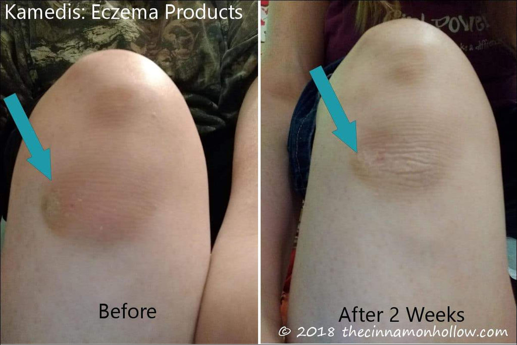 Relieve The Symptoms Of Eczema With Botanical Based Kamedis